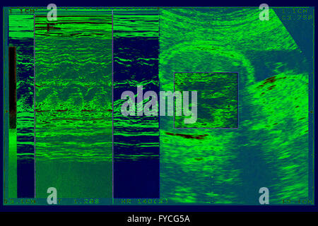 FÖTUS-ULTRASCHALL Stockfoto