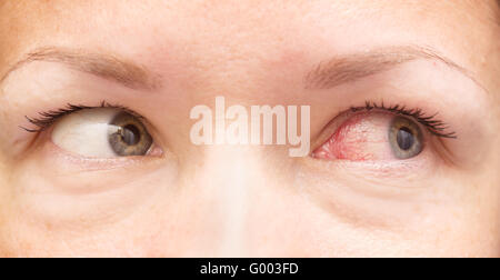 gesund und gereizte Augen Stockfoto