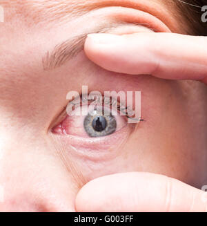 gereizte Augen Stockfoto