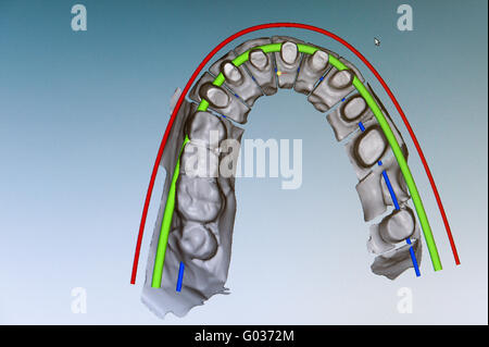 Darstellung des Oberkiefer-Modells auf die monit Stockfoto