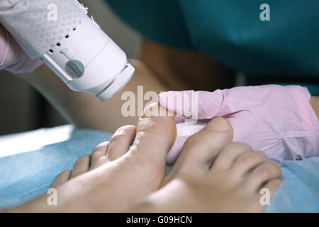 Behandlung von Onychomykose mit einem Laser Fußpflegerin Stockfoto