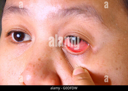 Asiatin mit rote gereizte Augen mit ihrem Finger um ihr Auge zu öffnen Stockfoto