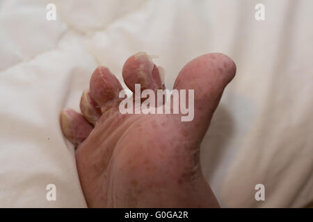 Schälen der Haut nach viralen Hautkrankheit - Closeup Fuß Stockfoto