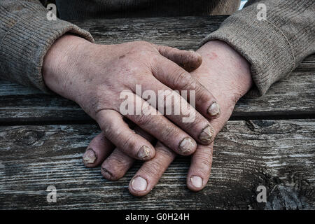 Pilzinfektion auf Nägel Hand älterer Mann Stockfoto