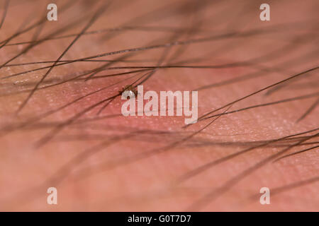 Zecken beißen behaarten Arm des Mannes. Eine kleine Nymphe Schafe Zecke (Ixodes Ricinus) ernähren sich von Blut durch die Haut der Person. Stockfoto