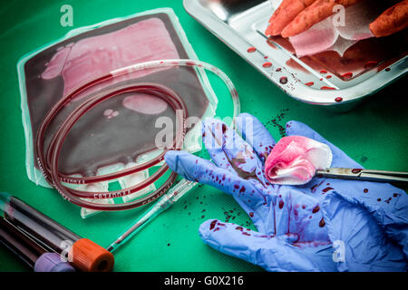 Einheit der Konzentration der roten Blutkörperchen, blutstillende Kocher Pinzette, Transplantation des oberen Extremität in einem OP-Raum Stockfoto