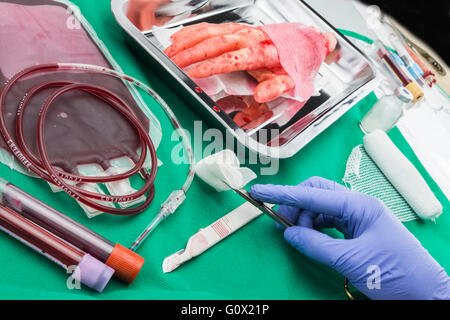 Einheit von Konzentrat roter Blutkörperchen, Transplantation des oberen Extremität in einem OP-Raum Stockfoto