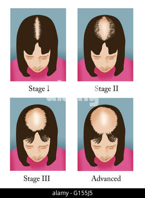 Progressive Stadien des Haarausfalls bei Frauen anhand der Ludwig Scale. Stockfoto