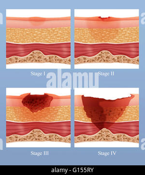 Darstellung der Phasen des von einem Bett wund oder Dekubitus. Wundliegen können durch viele Faktoren wie unrelieved Druck, Reibung, Feuchtigkeit usw. verursacht werden. Wundliegen leiden in der Regel die gebrechliche und ältere Menschen, Menschen Rollstuhl gebunden und die unheilbar Stockfoto