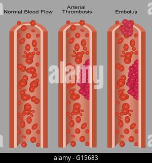 Darstellung einer normalen Arterie und diejenigen mit Blutgerinnseln (arterielle Thrombose und Lungenembolie).  Eine Lungenembolie ist eine freistehende, Reisen intravaskulären Masse durchgeführt durch Zirkulation, die arterielle Kapillare Betten verstopfen kann.  Arterielle Thrombose ist th Stockfoto