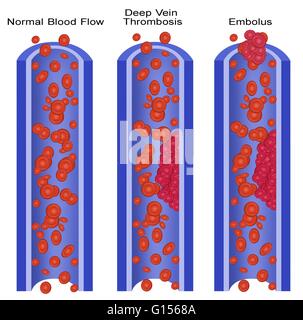 Darstellung eine normale Vene und mit tiefen Beinvenenthrombose (TVT) und Lungenembolie.  Eine Lungenembolie ist eine freistehende, Reisen intravaskulären Masse durchgeführt durch Zirkulation, die arterielle Kapillare Betten verstopfen kann.  Tiefe Venenthrombose oder tiefen veno Stockfoto