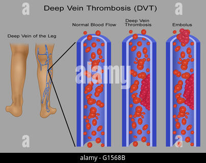 Darstellung eine normale Vene und mit tiefen Beinvenenthrombose (TVT) und Lungenembolie.  Eine Lungenembolie ist eine freistehende, Reisen intravaskulären Masse durchgeführt durch Zirkulation, die arterielle Kapillare Betten verstopfen kann.  Tiefe Venenthrombose oder tiefen veno Stockfoto