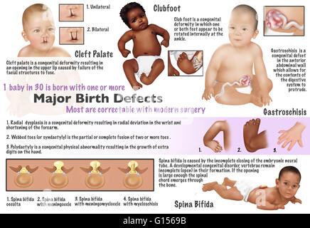 Illustration von Missbildungen bei Babys gefunden. Gaumenspalte, Klumpfuß, radiale Dysplasie, Schwimmhäuten zwischen Zehen, Polydaktylie, Gastroschisis und Spina Bifida. 1 Baby in 30 ist mit einem oder mehreren großen Missbildungen geboren. Die meisten sind mit modernen Chirurgie korrigierbar. Stockfoto