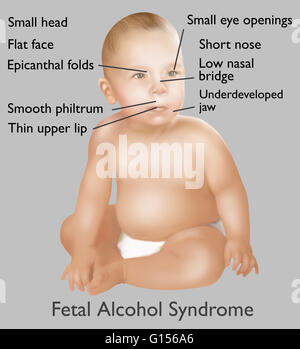 Abbildung des Babys mit fetalen Alkoholsyndrom. Fetal Alcohol Syndrome oder (FAS) ist eine Erkrankung bei Säuglingen, die durch Alkoholkonsum der Mutter während der Schwangerschaft verursacht wird. Geistige und körperliche Defekte wie ein kleiner Kopf, flaches Gesicht, epicanth Stockfoto