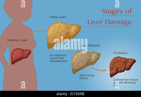 Phasen von Leberschäden durch Alkoholismus. Ersten Alkohol beeinträchtigt die Leber, verursacht große Fettdepots zu entwickeln und Vergrößerung der Leber (Fettleber); Wenn dies fortschreitet, Auftritt Narbengewebe bildet und mehr Leberzelle Verletzung (Fibrose); Fina Stockfoto