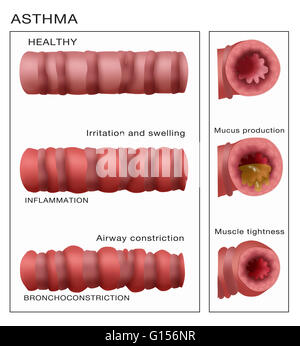 Abbildung zeigt die Entwicklung der Bronchialsystem Einschnürung wiederum Asthma. Oben rechts ist eine gesunde Bronchialsystem unten zeigt, dass einige Entzündungen und Schleimproduktion, und schließlich an der Unterseite hat das Bronchialsystem verringert und die Atemwege ist co Stockfoto