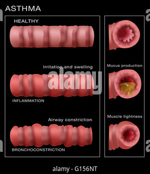 Abbildung zeigt die Entwicklung der Bronchialsystem Einschnürung wiederum Asthma. Oben rechts ist eine gesunde Bronchialsystem unten zeigt, dass einige Entzündungen und Schleimproduktion, und schließlich an der Unterseite hat das Bronchialsystem verringert und die Atemwege ist co Stockfoto