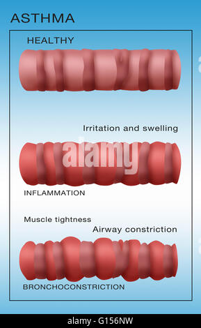 Abbildung zeigt die Entwicklung der Bronchialsystem Einschnürung wiederum Asthma. Oben rechts ist eine gesunde Bronchialsystem unten zeigt, dass einige Entzündungen und Schleimproduktion, und schließlich an der Unterseite hat das Bronchialsystem verringert und die Atemwege ist co Stockfoto