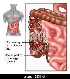 Abbildung zeigt Morbus Crohn. Morbus Crohn ist als eines der wichtigsten Formen der entzündlichen Darmerkrankungen oder IBD kategorisiert. Stockfoto