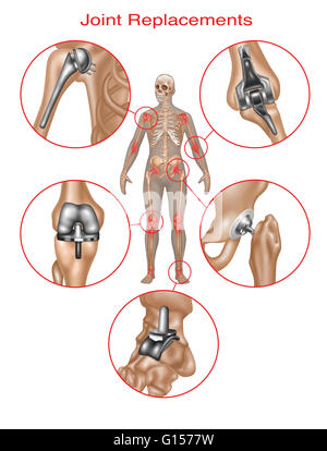 Darstellung, die Gemeinplätze von Gelenkersatz des menschlichen Skeletts. Stockfoto