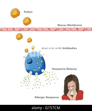Abbildung zeigt den Prozess einer allergischen Reaktion. Stockfoto