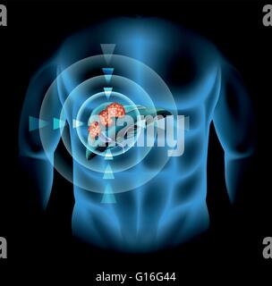 Leberkrebs-Diagramm zeigt Details Abbildung Stock Vektor