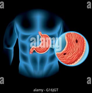 Magengeschwür Diagramm in der Abbildung Stock Vektor