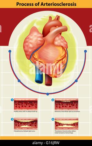 Plakat der Arteriosklerose-Prozess-Abbildung Stock Vektor