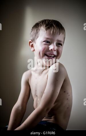 -MODELL VERÖFFENTLICHT. Junge mit Windpocken, lächelnd. Stockfoto