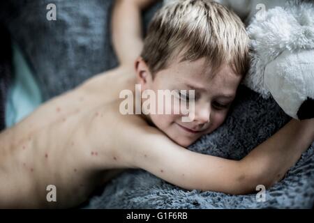 -MODELL VERÖFFENTLICHT. Junge liegend mit Windpocken. Stockfoto