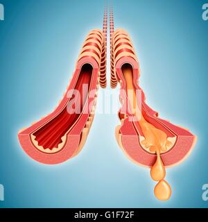 Infizierten menschlichen Bronchus der Lunge, Abbildung. Stockfoto
