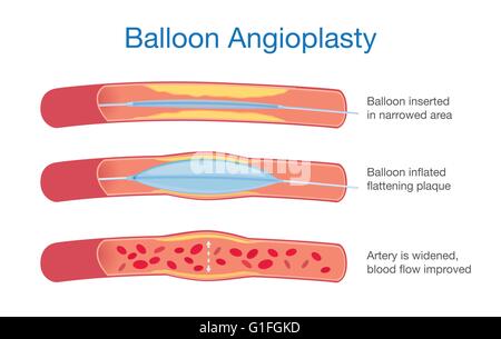 Ballon-Angioplastie-Verfahren Stock Vektor