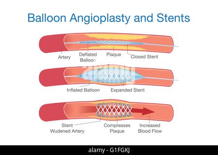 Ballon-Angioplastie und Stents-Verfahren Stock Vektor