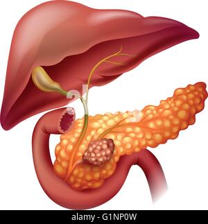 Bauchspeicheldrüse Krebs Diagramm auf weißen illustration Stock Vektor