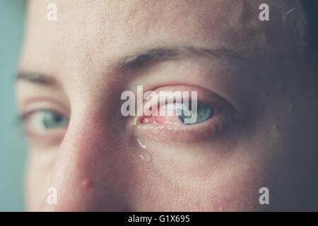 Eine Frau weinende Augen blutunterlaufen hautnah Stockfoto