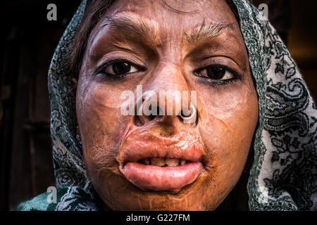 Vernarbten Gesicht einer Frau in Delhi, Indien Stockfoto