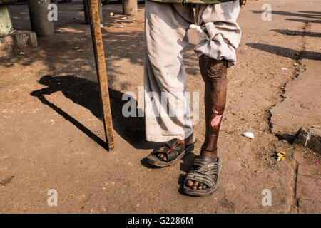 Mann mit schlechten Bein ausgesetzt, mit Stick zum Wandern in Delhi, Indien. Stockfoto