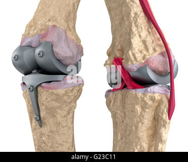 Knie und Titan Scharniergelenk. Isoliert auf weiss Stockfoto