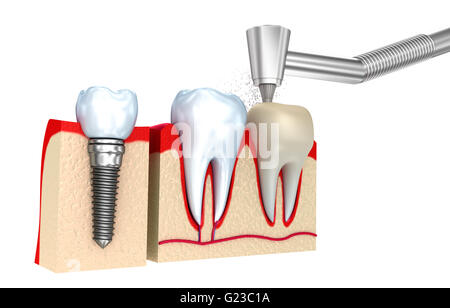 Zahnkrone Installationsprozess, isoliert auf weiss Stockfoto