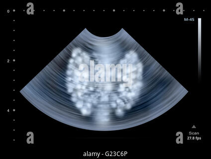 Ultraschalluntersuchung der menschlichen Schilddrüse. Abbildung Stockfoto