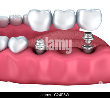 3D unteren Zähne und Zahnimplantaten isoliert auf weiss Stockfoto