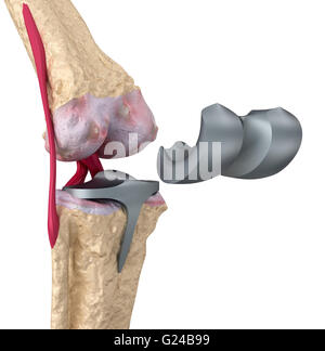 Knie und Titan Scharniergelenk. Isoliert auf weiss Stockfoto