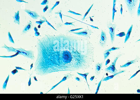 PC-3 menschlichen Prostatakrebszellen, befleckt mit Coomassie Blau, unter differen Interferenz-Kontrast-Mikroskop. Stockfoto