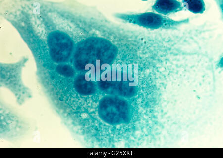 PC-3 menschlichen Prostatakrebszellen, befleckt mit Coomassie Blau, unter differen Interferenz-Kontrast-Mikroskop. Stockfoto