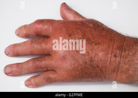 Arthritischen Hand eines älteren Mannes Stockfoto