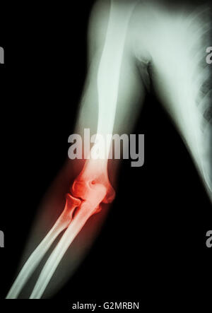 Arthritis Bei Ellenbogen Roentgenfilm Arm Ellenbogen Unterarm Und Entzundung Am Ellenbogen Gicht Arthritis Rheumatoide Arthritis Stockfotografie Alamy