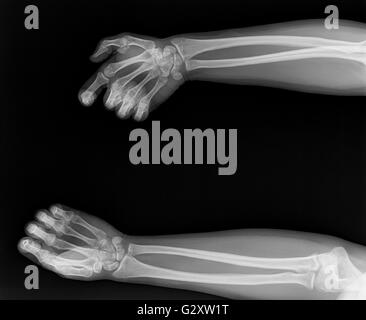 Menschliche Skelettanatomie mit zwei Ansichten von Armen, Händen und Handgelenken mit Knochen, Gelenken, Radius, Ulna, Karpalen, Metakarpale und Phalangen für die Medizin Stockfoto