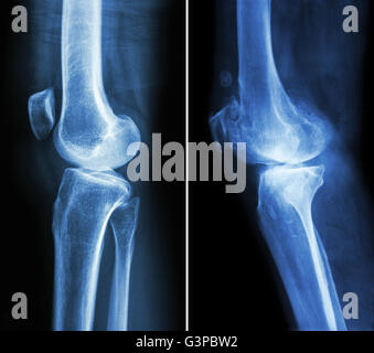 normalen Knie (linkes Bild) und Arthrose Knie (rechtes Bild) (seitliche Ansicht) Stockfoto