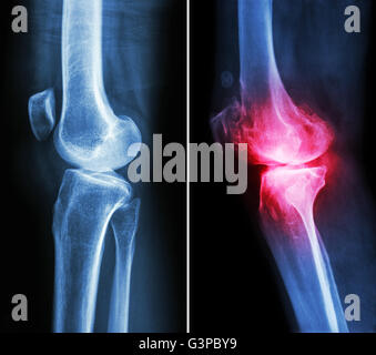 normalen Knie (linkes Bild) und Arthrose Knie (rechtes Bild) (seitliche Ansicht) Stockfoto