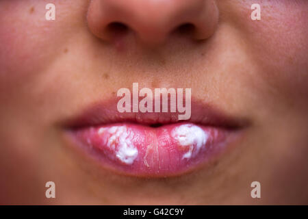 Herpes Simplex-Virus Typ 2, Abbildung Stockfotografie - Alamy